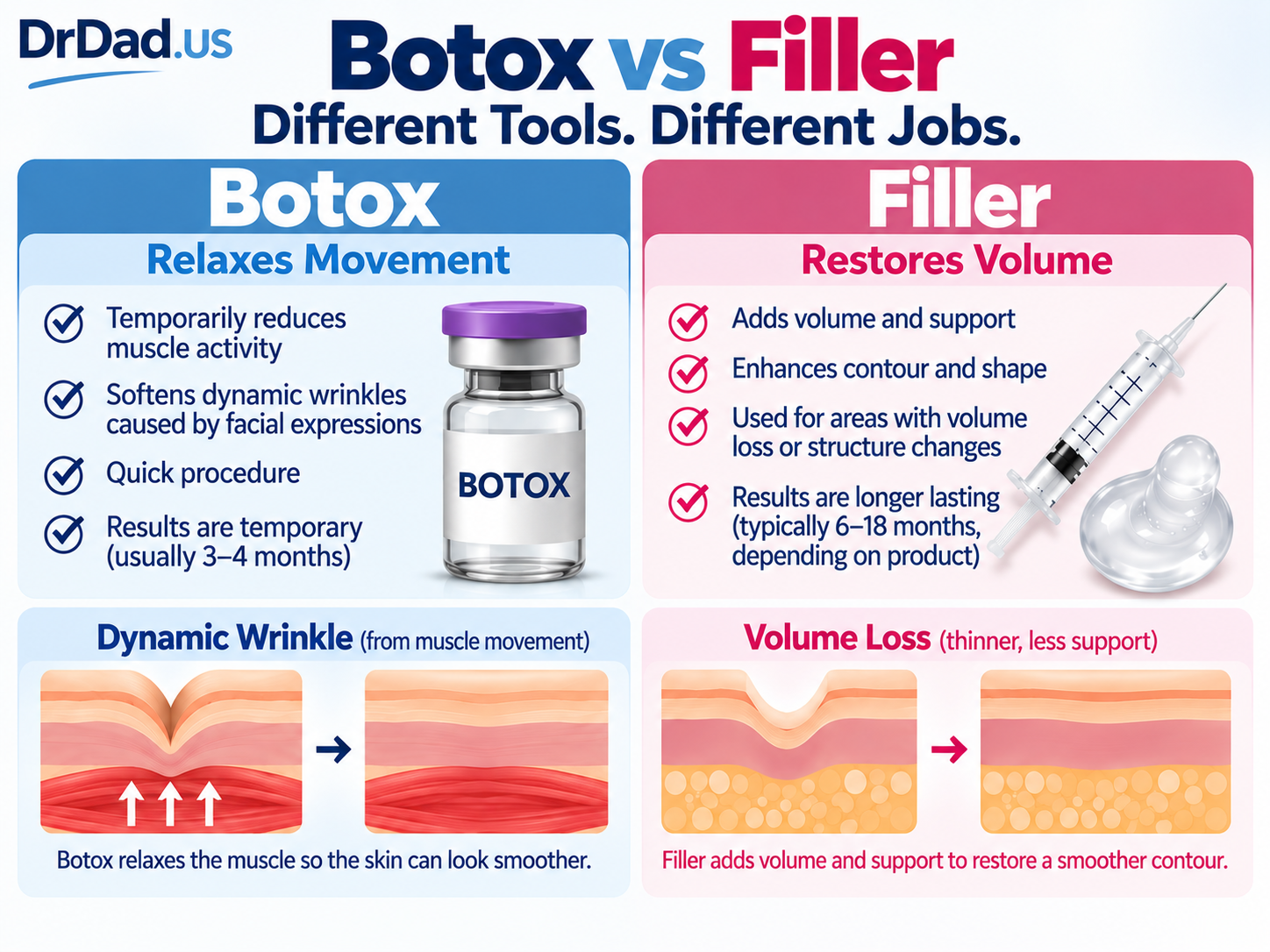 Botox vs filler infographic comparing movement-related wrinkles and volume loss