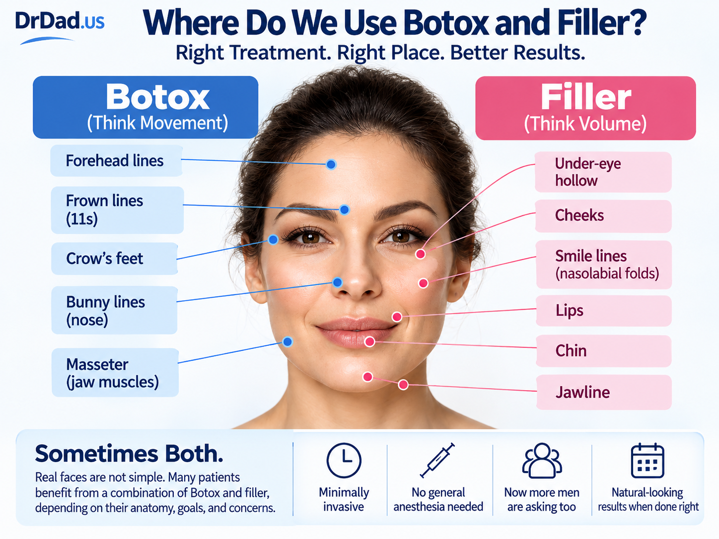 Facial map showing common Botox and dermal filler treatment areas