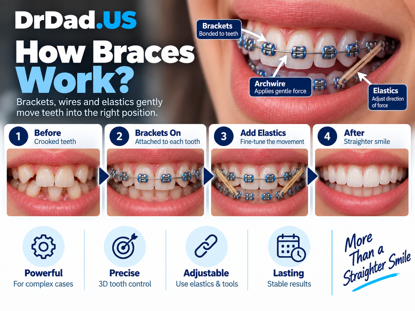 Clear aligners and tooth attachments used in Invisalign treatment